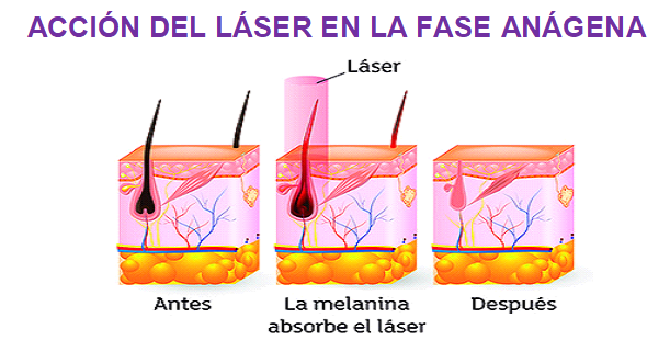 La depilacion funciona laser como