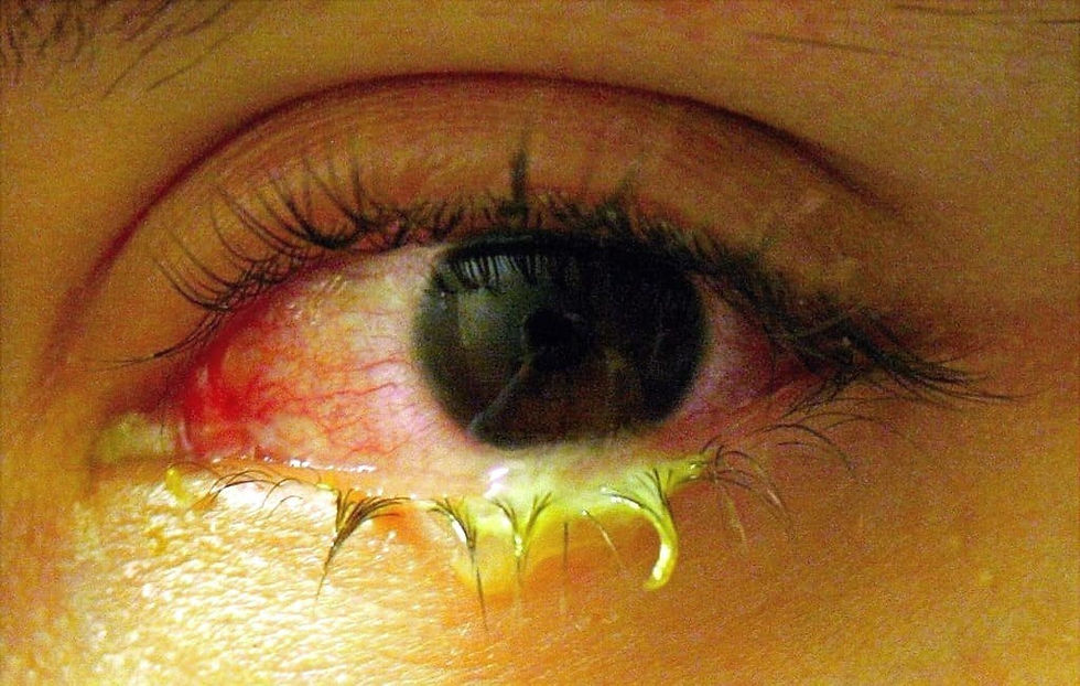 التهاب الملتحمة البكتيري (Bacterial conjunctivitis)
