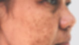 hyperpigmentation.jpg