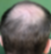 hair loss.png