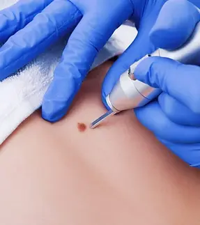Cryotherapy SE1 Medical Aesthetics London