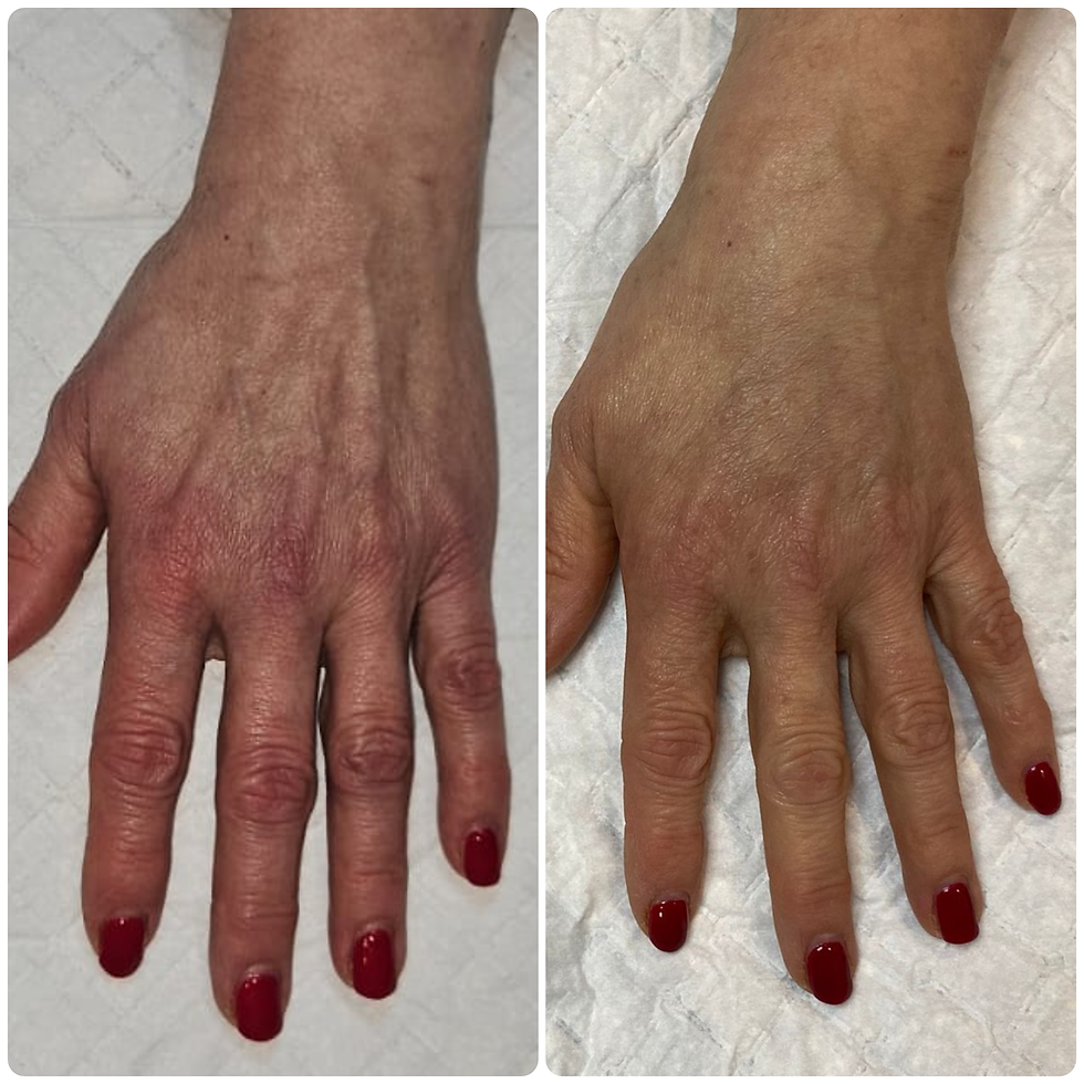 Dr Lorenzo B-FAB Hand Rejuvenation