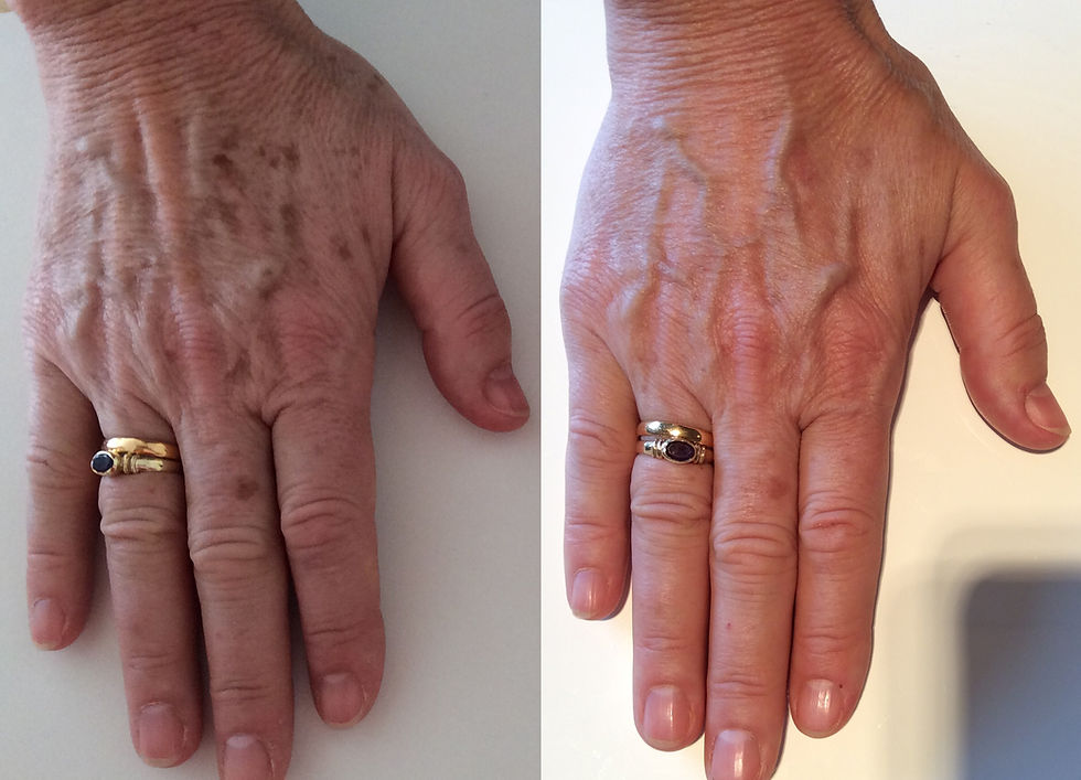 Lumecca IPL with Dr Lorenzo for hands
