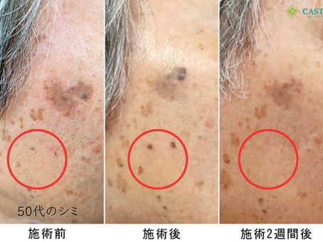 プラズマスポットのシミ取りってどんな感じ?