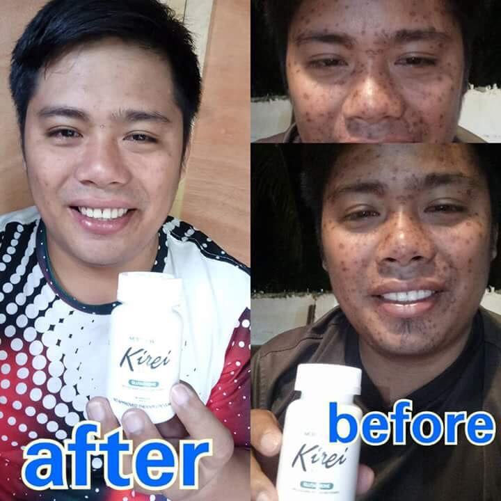 Thumbnail: Kirei Capsules Skin Whitening Glutathione Capsules, 30 Capsule