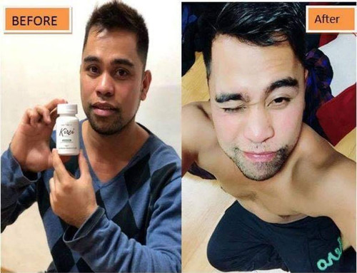 kirei glutathione review before and after HA Rejuve Results with & Hyaluronic Acid Microneedling & Photos New Jersey Glutathione Treatment in Turkey |