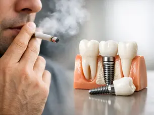 Can Smokers Get Dental Implants?