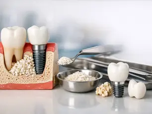 Bone Grafting for Dental Implants Explained