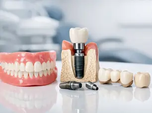 Best Tooth Replacement Options Explained