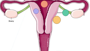 What Are Uterine Fibroids — And Why Location Matters More Than Size