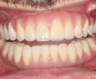 nj best dentist full arch implants all on x