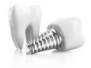 Implantes dentales en Mérida, Yucatán: cuando la experiencia clínica marca la diferencia