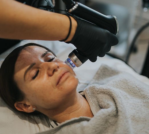 3D Trimax Fractional Radiofrequency_edit