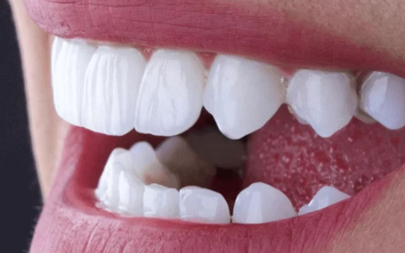 phục hình răng sứ thẩm mỹ