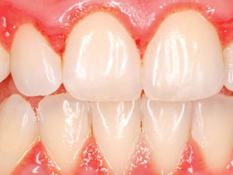 Bọc Răng Sứ Bị Viêm Lợi: Nguyên Nhân và Giải Pháp