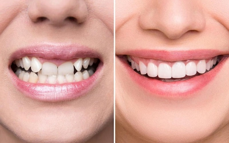 trước và sau khi bọc răng sứ