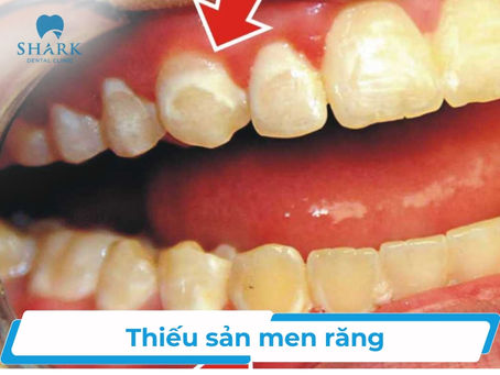 Khám Phá Về Bệnh Thiếu Sản Men Răng: Nguyên Nhân, Triệu Chứng và Cách Điều Trị Hiệu Quả