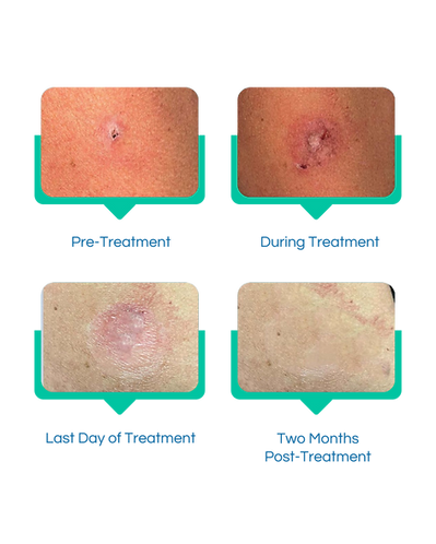 Treatment Progression (Instagram Post (45)) (2).png