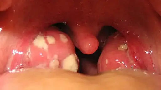 التهاب اللوزتين 