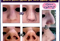 _تجميل الأنف ، الصورة قبل وبعد١