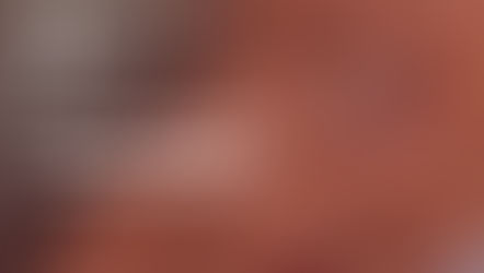 Perdi a prótese: isso é uma emergência?