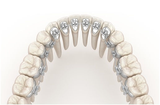 teeth, braces