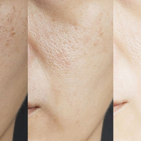 How To Remove Dark Spots Caused By Acne: Treatment, Home Remedies