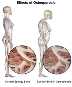 7 Common FAQ’S on Bone Diseases