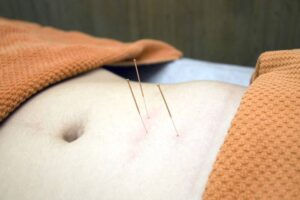 Acupuncture needles being used.