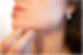 Acne scars