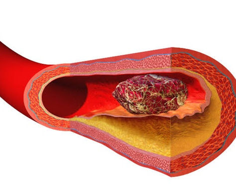 Why Do Clots Form and How Dangerous are They?