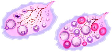 PCOS VS PCOD: What’s the Difference?