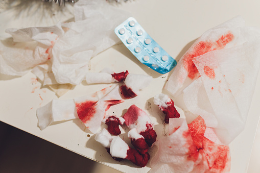 nose bleed in pregnancy miscarraige