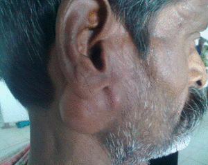 tags: Symptom of a tumour