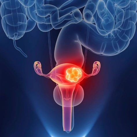 Meigs Syndrome: Causes, Symptoms, Diagnosis and Treatment