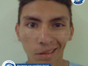 Todo sobre la Parálisis Facial: síntomas, causas, diagnóstico y tratamiento.