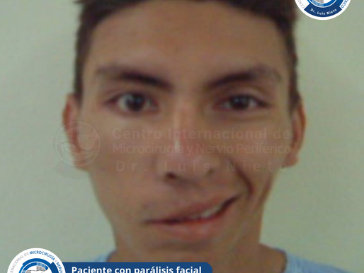 Todo sobre la Parálisis Facial: síntomas, causas, diagnóstico y tratamiento.