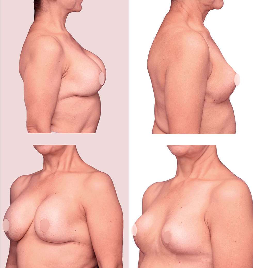 Antes y Después. Retiro de Implantes, 2025