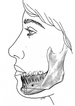 MENTOPLASTIA.png