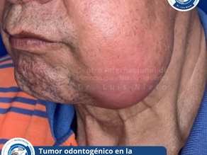 La Microcirugía en el tratamiento de tumores odontogénicos