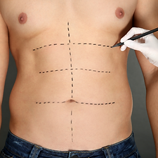 Abdominoplastia.png