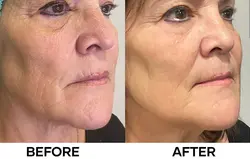 Revok50-Before-After3