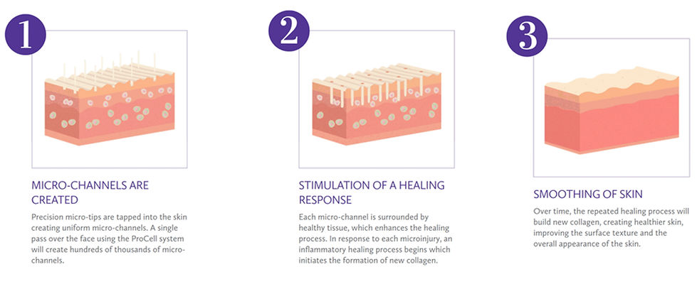 Procell Microchanneling works in 3 intelligent stages