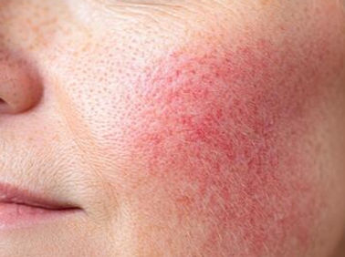 Rosacea_edited.jpg