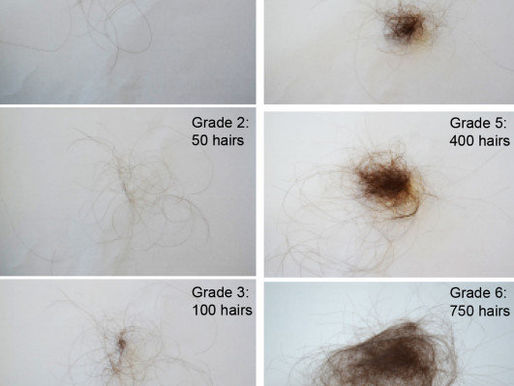 Perdita dei capelli - Alopecia - Trattamenti Milano