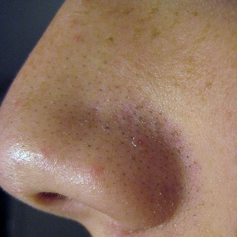 Best Ways to Get Rid of Blackheads