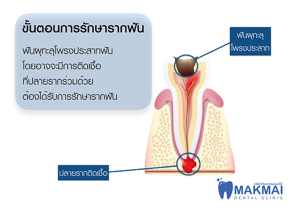 ขั้นตอนรักษารากฟัน