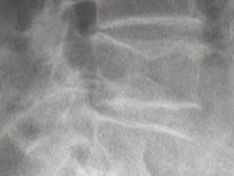 Osteoporose - Knochenschwund