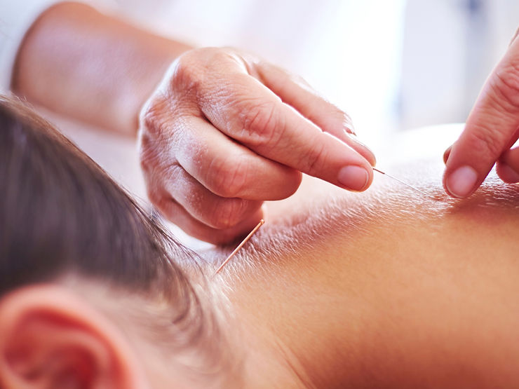 Acupuncture session.