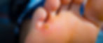 MyPODO_Teilbehandlung_Hühnerauge_entfernen_1920x800px.jpg